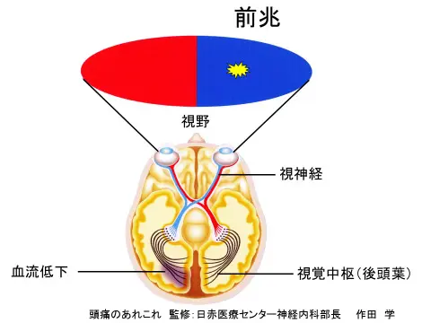 片頭痛 | まえさこ医院